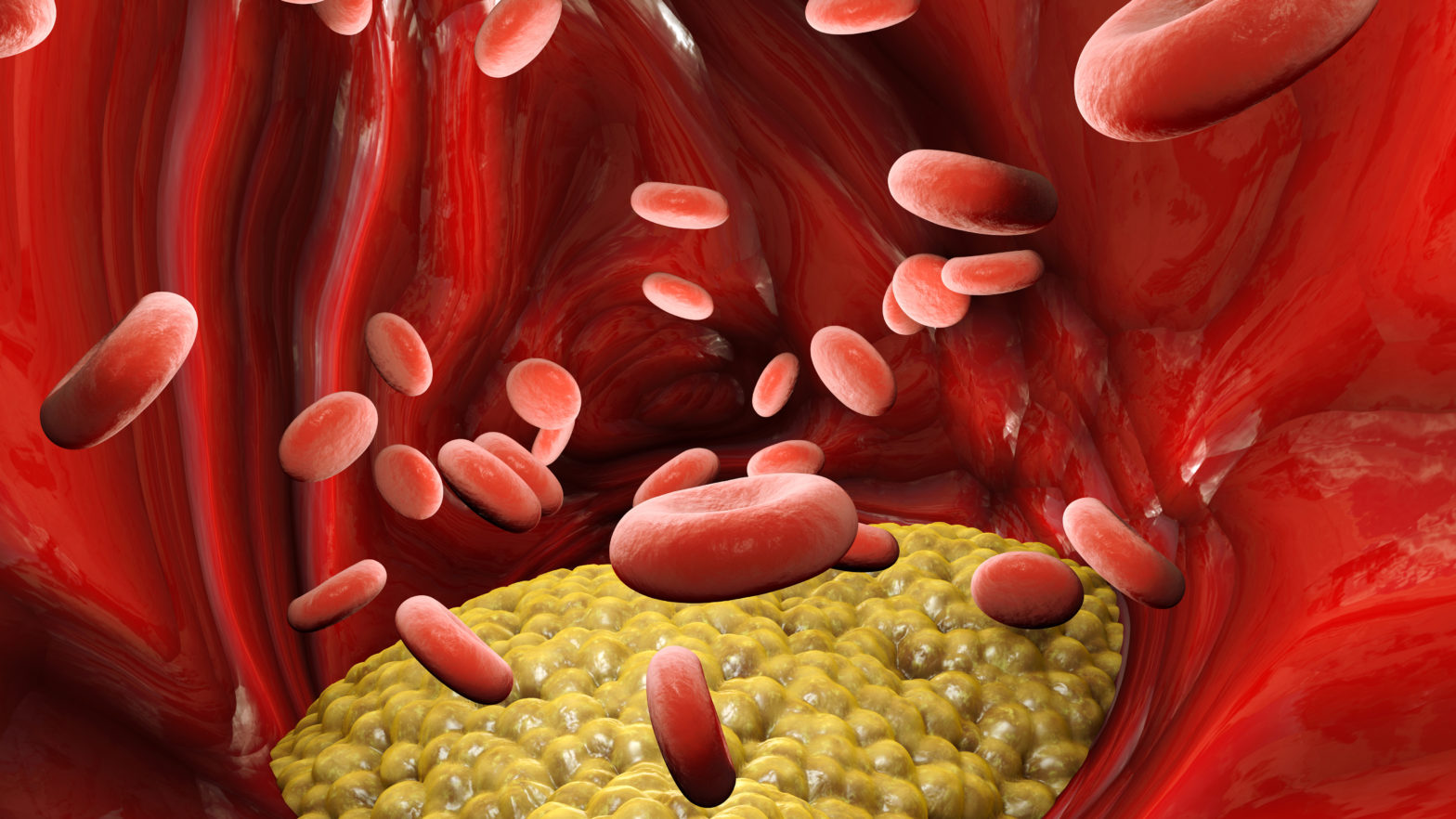 Cholesterol formation, fat, artery, vein, heart. Red blood cells, blood flow. Narrowing of a vein for fat formation, 3d render