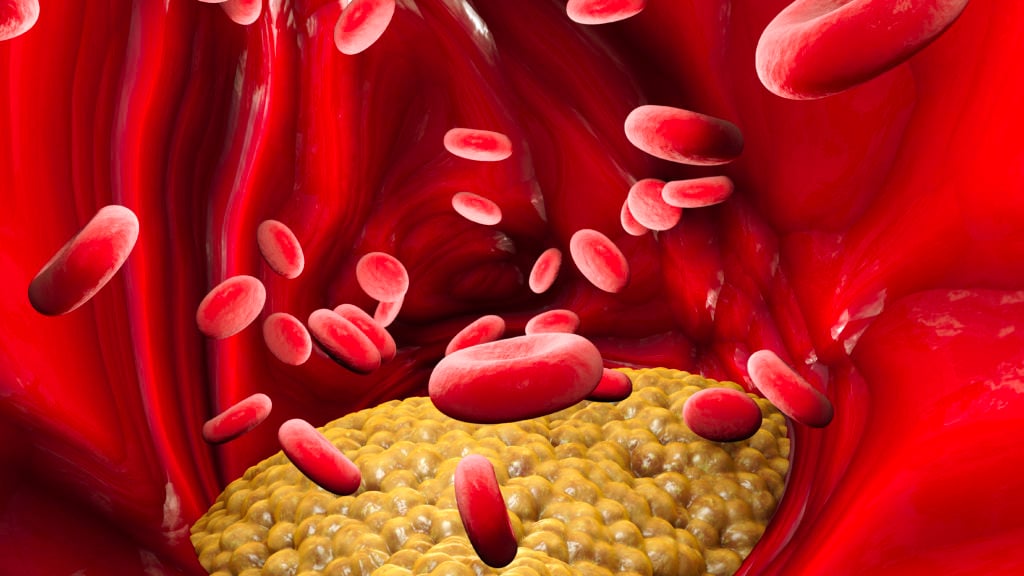 La formazione del colesterolo in una vena